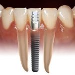 dental implants