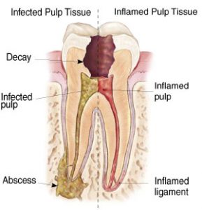 endodontictreatment