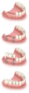 implant several teeth