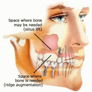 oral surgery - tooth extraction dentist Melbourne