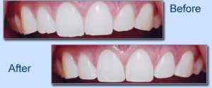 recontouringofteeth