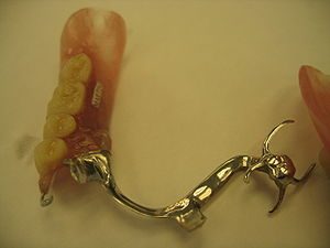 removable partial denture