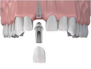 singletoothmissing