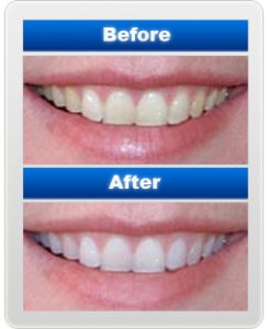 teethwhitening