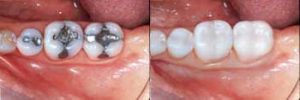 white fillings