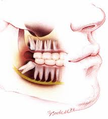 wisdom teeth dentist Melbourne